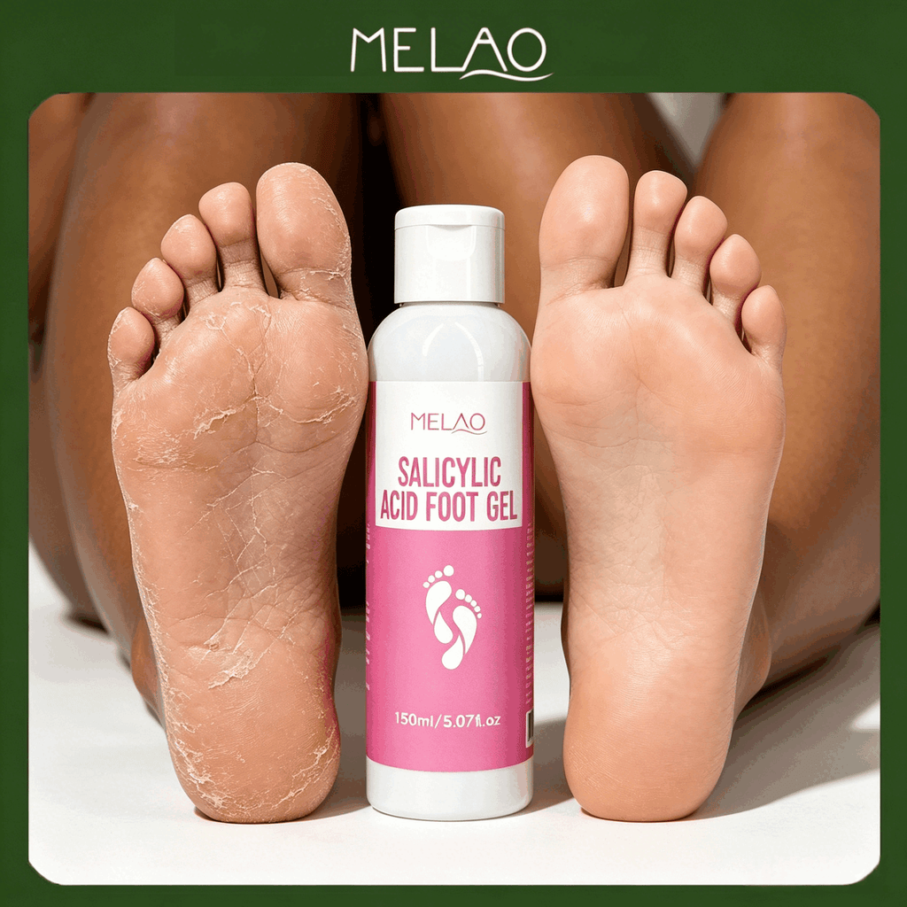 MELAO Salicylic Acid Foot Gel - Dead Skin & Callus Remover, Exfoliating Treatment for Rough Cracked Feet, Softens Heels, 150ml