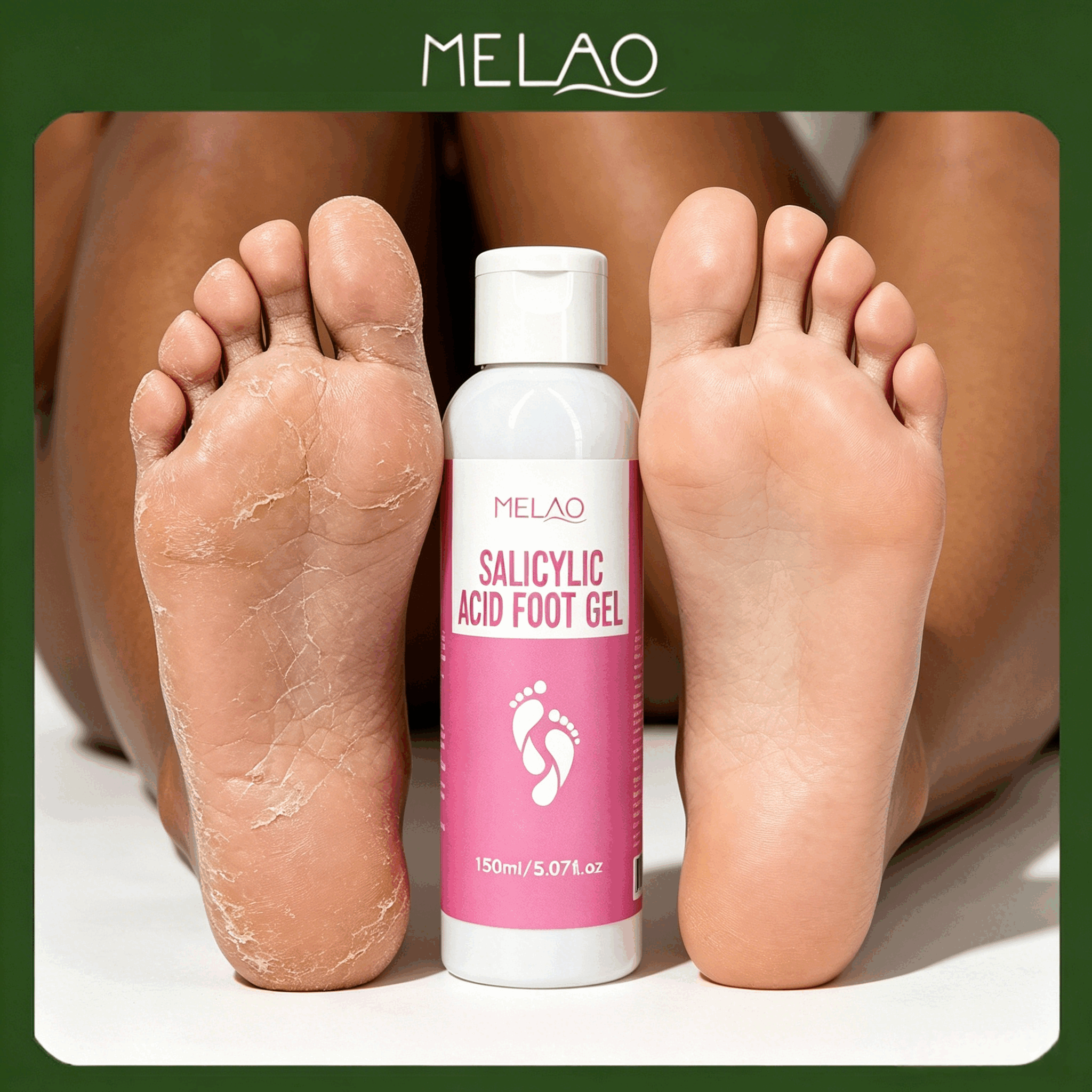 MELAO Salicylic Acid Foot Gel - Dead Skin & Callus Remover, Exfoliating Treatment for Rough Cracked Feet, Softens Heels, 150ml